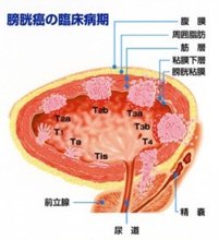 早期見極めが重要に　排尿絡む症状は受診を　膀胱がん総論　千葉県がんセンター泌尿器科主任医長　佐藤陽介　【９月はがん征圧月間　ちば　がんにうち克つ】（９）