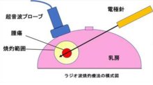 細い針刺し熱で焼灼　心身の負担より少なく　乳がんの切らない治療　千葉県がんセンター乳腺外科医長　羽山晶子　【９月はがん征圧月間　ちば　がんにうち克つ】（１１）