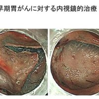 進む胃カメラ治療　死亡数３位に低下　胃がん（２）　千葉県がんセンター内視鏡科医長　北川善康　【９月はがん征圧月間　ちば　がんにうち克つ】（２）