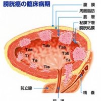 早期見極めが重要に　排尿絡む症状は受診を　膀胱がん総論　千葉県がんセンター泌尿器科主任医長　佐藤陽介　【９月はがん征圧月間　ちば　がんにうち克つ】（９）