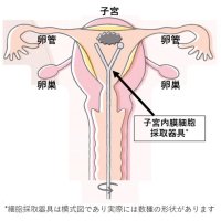 閉経後の出血に注意　「早期」で低侵襲手術も　子宮体がんの特徴　千葉県がんセンター婦人科医員　村岡純輔　【９月はがん征圧月間　ちばがんにうち克つ】（２）